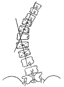 Измерение угла сколиотической дуги по методу Лекума
