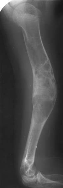 disecția osteochondrozei articulației cotului pentru dureri în articulația genunchiului